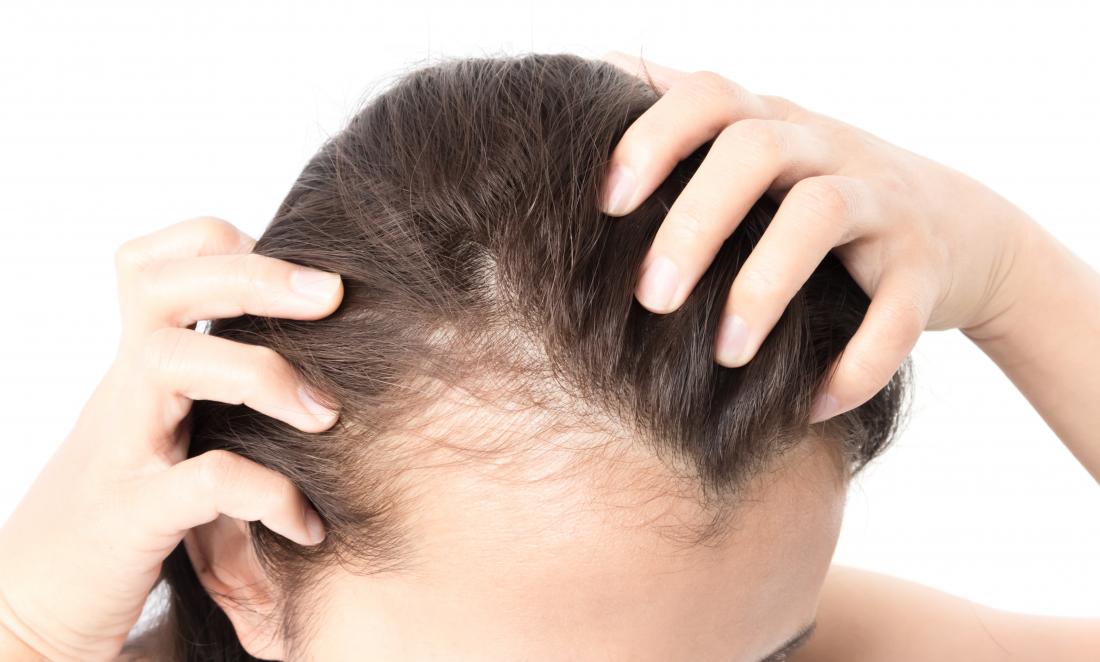 Hair loss treatment